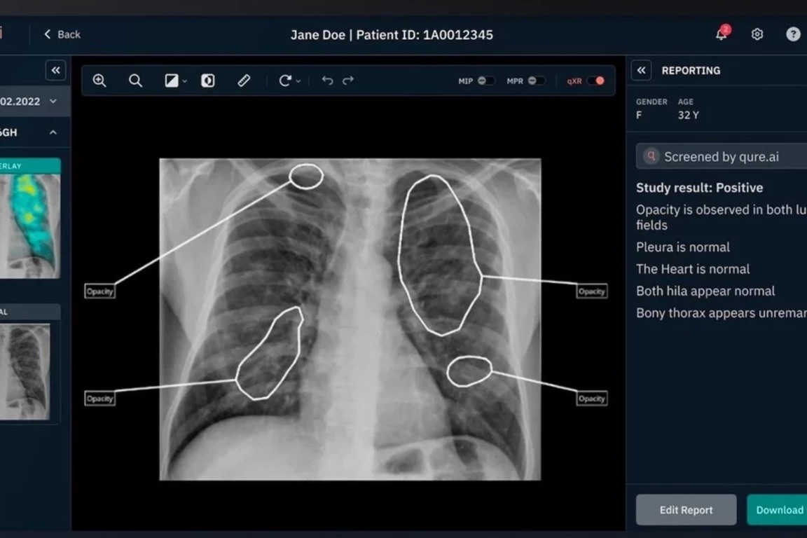 AI-Assisted X-Rays Cut TB Costs